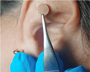Auriculoterapia