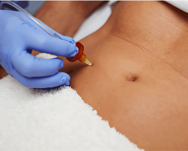 Carboxiterapia